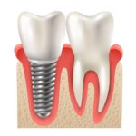 Descubra tudo sobre implantes dentários