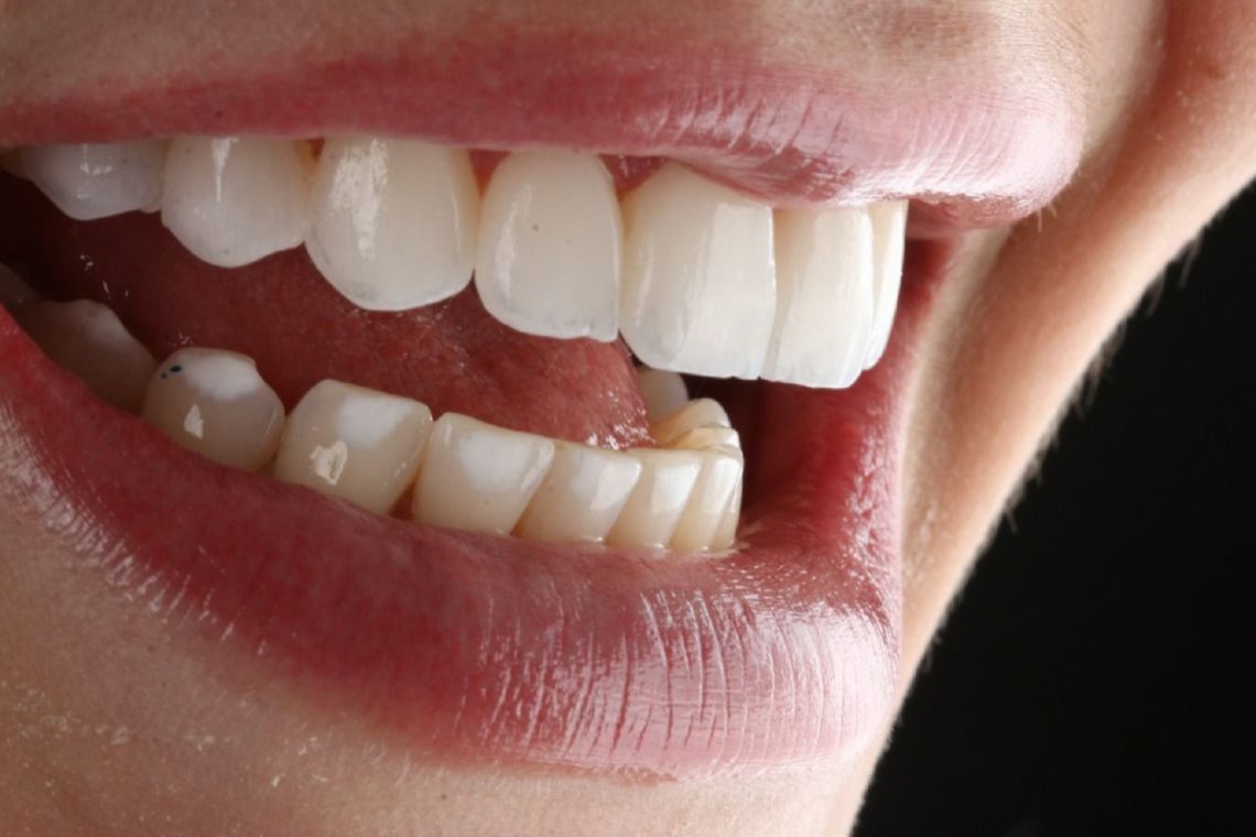 Implante odontológico: afinal, dói?