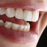 Implante odontológico: afinal, dói?