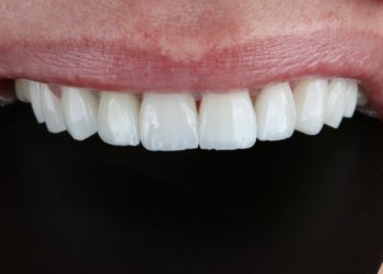 Qual a durabilidade das lentes de contato dental? descubra agora
