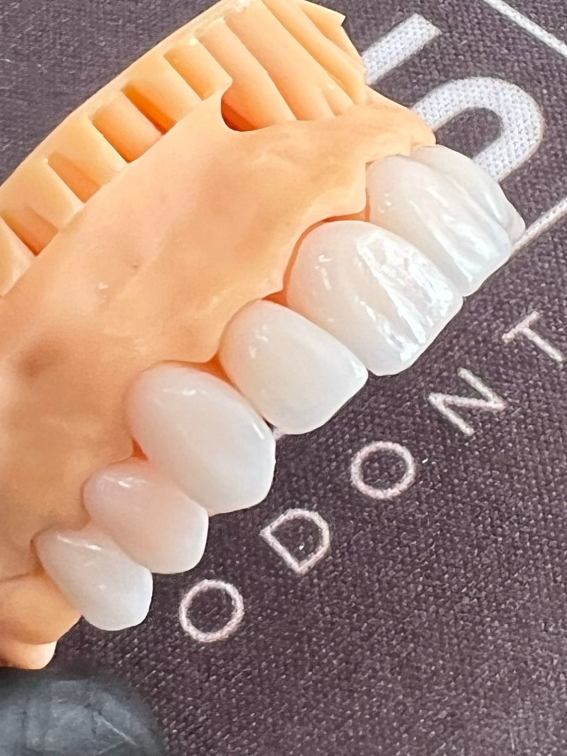 Duração de implante dentário: entenda aqui