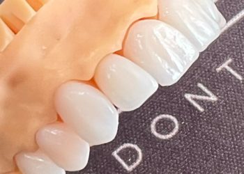 Duração de implante dentário: entenda aqui